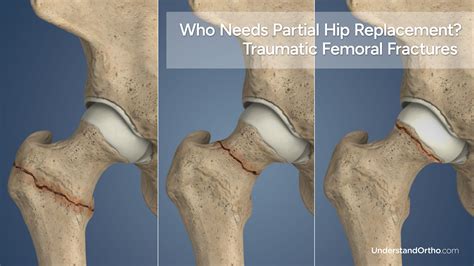 hip surgery aberdeen|Hip surgery in Aberdeen .